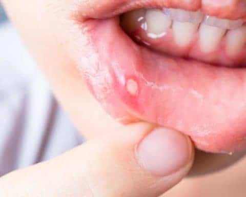 How Long Do Cold Sores Last