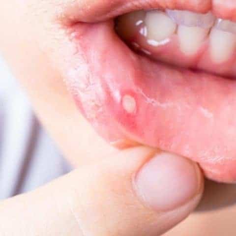 How Long Do Cold Sores Last