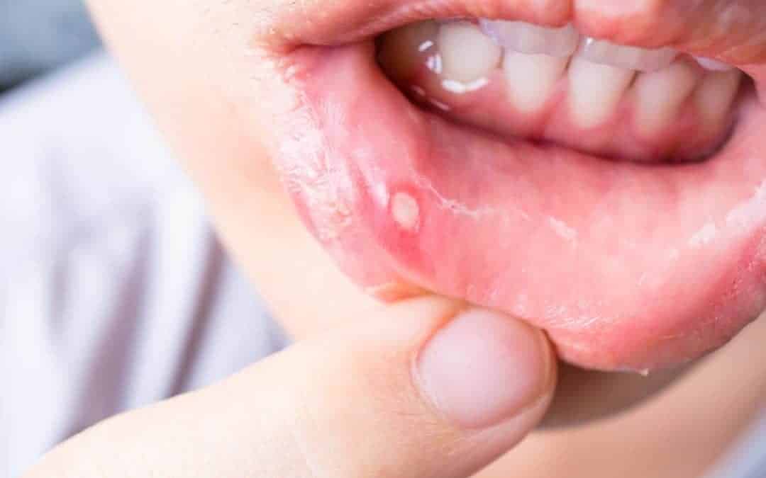 how-long-do-cold-sores-last